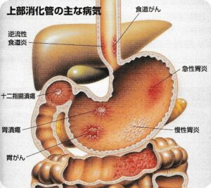 上部消化管の主な病気